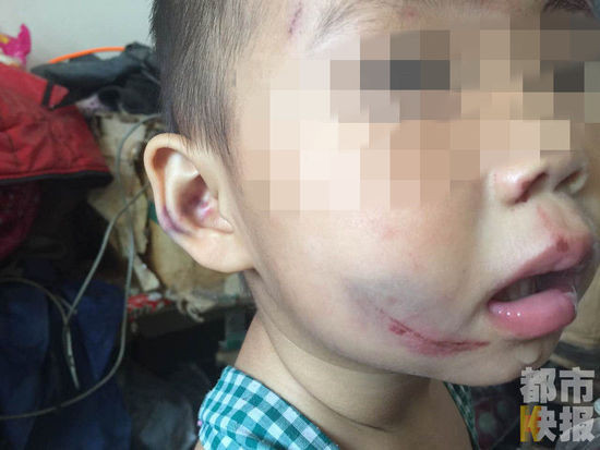 2岁女孩遭母亲殴打遍体鳞伤 父亲街头痛哭求助